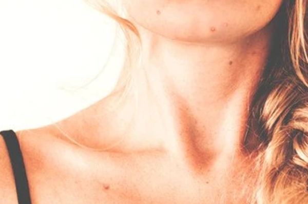 Adult Acne