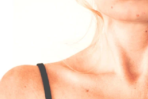 Adult Acne